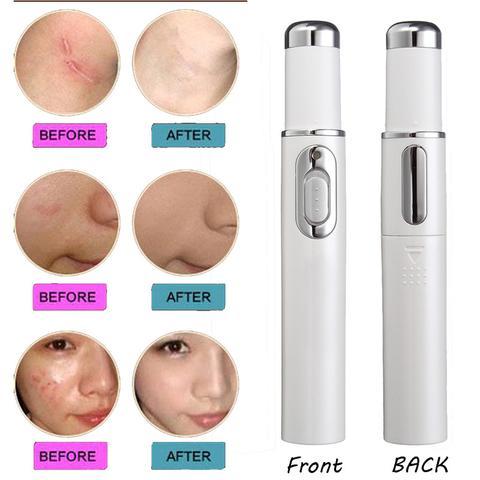 Blue Light Therapy Acne Laser Pen Soft Scar Wrinkle Removal Treatment Device Skin Care Beauty Equipment-0-Rambla Store