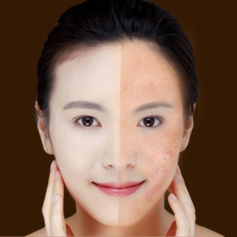 Blue Light Therapy Acne Laser Pen Soft Scar Wrinkle Removal Treatment Device Skin Care Beauty Equipment-0-Rambla Store